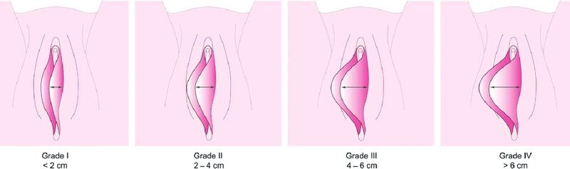 Асимметрия половых губ. Причины, коррекция