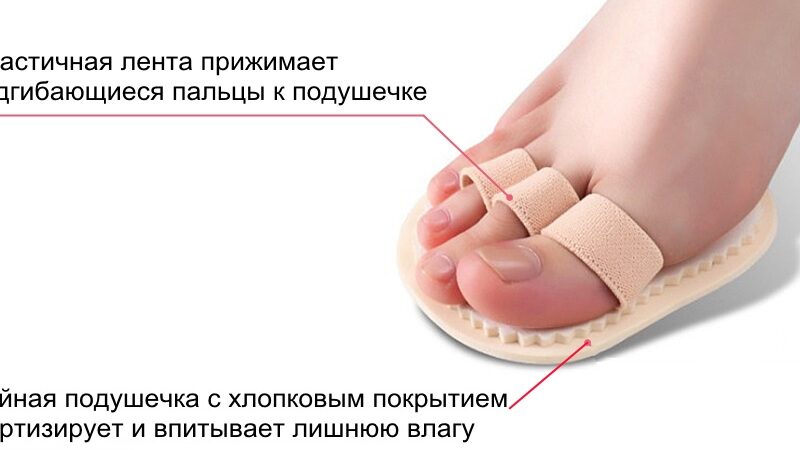 Кривые пальцы на ногах. Как исправить, что делать